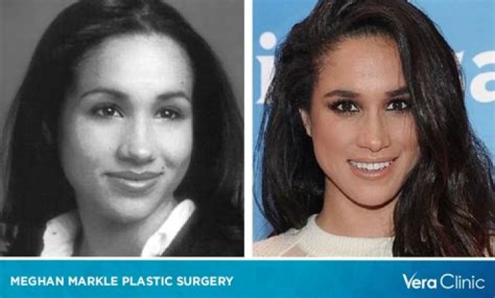 Did Meghan Markle Have Plastic Surgery: Before & After!